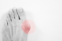 Overview of Bunions