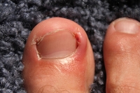 Types of Ingrown Toenails