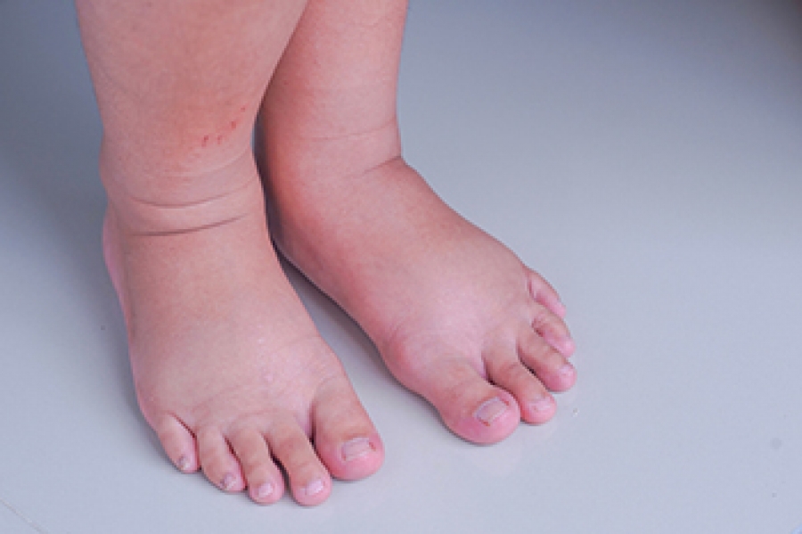 Foot Pain and Leg Problems in Pregnancy