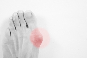 Bunion Surgery